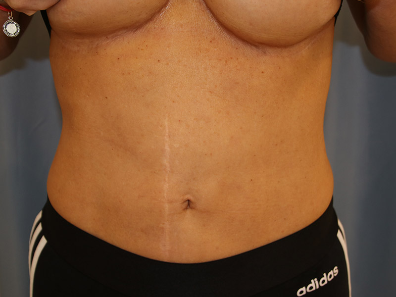 Tummy Tuck Before and After | Dr. Leslie Stevens
