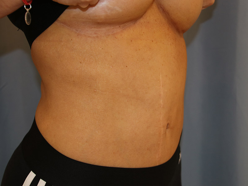 Tummy Tuck Before and After 14