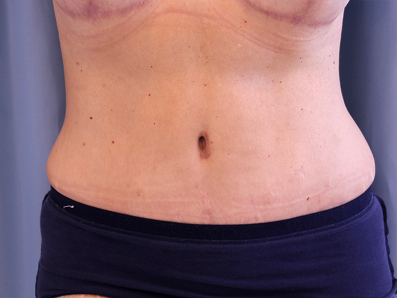 Tummy Tuck Before and After 14