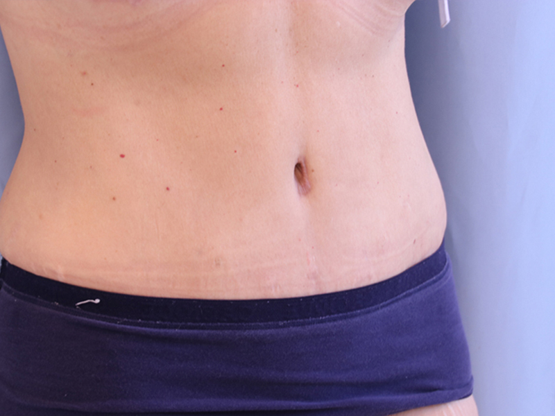 Tummy Tuck Before and After 15