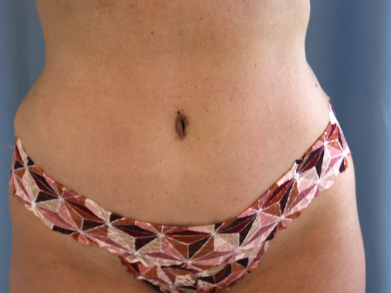 Tummy Tuck Before and After | Dr. Leslie Stevens