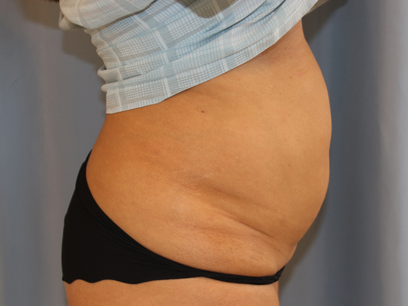 Tummy Tuck Before and After 16