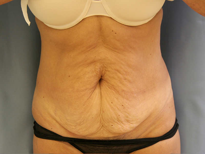 Tummy Tuck Before and After | Dr. Leslie Stevens