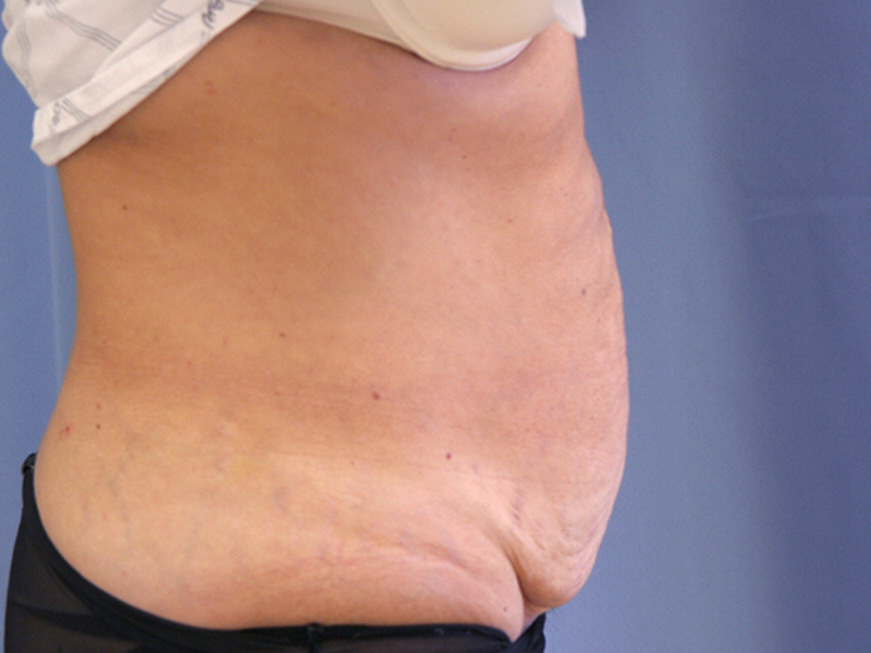 Tummy Tuck Before and After 17