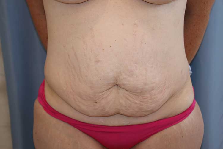 Tummy Tuck Before and After | Dr. Leslie Stevens