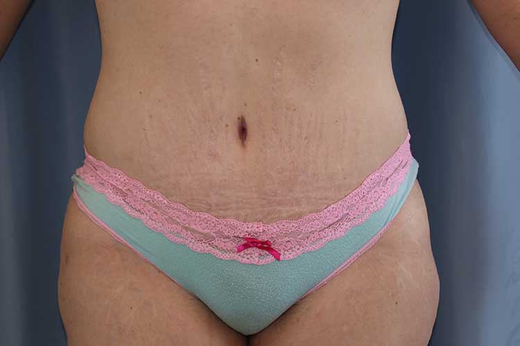 Tummy Tuck Before and After | Dr. Leslie Stevens