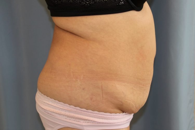 Tummy Tuck Before and After 19