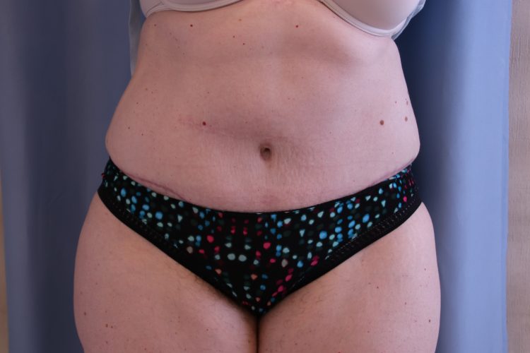 Tummy Tuck Before and After 09