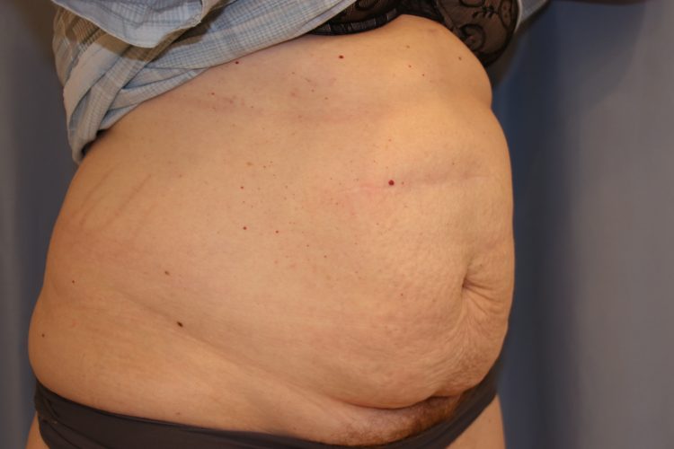 Tummy Tuck Before and After 20