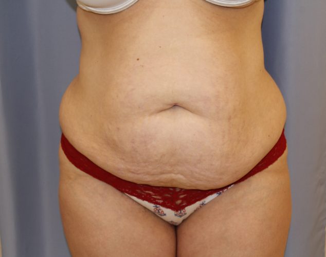 Tummy Tuck Before and After | Dr. Leslie Stevens