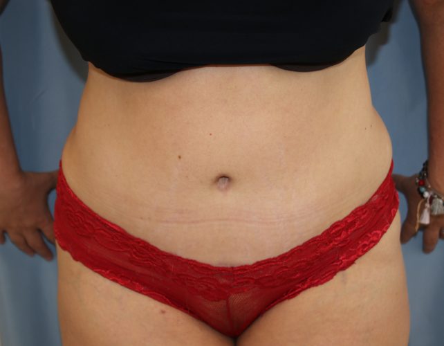 Tummy Tuck Before and After | Dr. Leslie Stevens