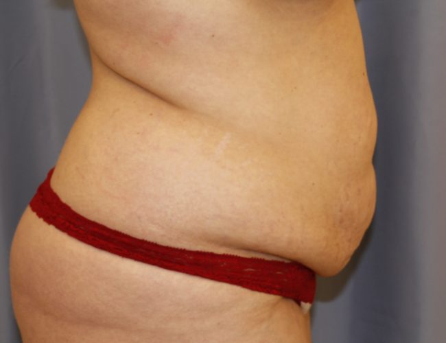 Tummy Tuck Before and After 21