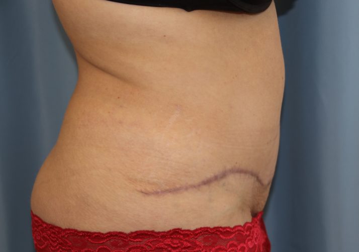 Tummy Tuck Before and After 21