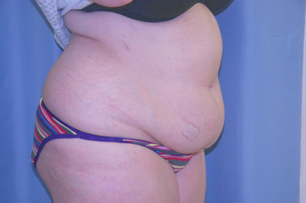 Tummy Tuck Before and After 24