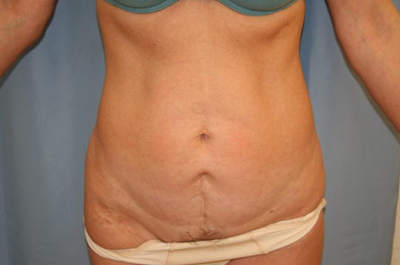 Tummy Tuck Before and After 25