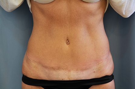 Tummy Tuck Before and After 14