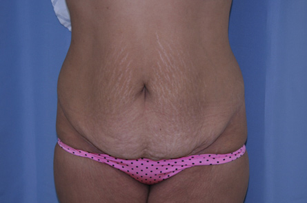 Tummy Tuck Before and After 26