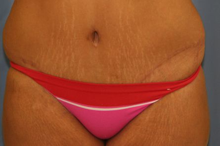 Tummy Tuck Before and After 13