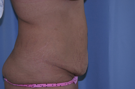 Tummy Tuck Before and After 26