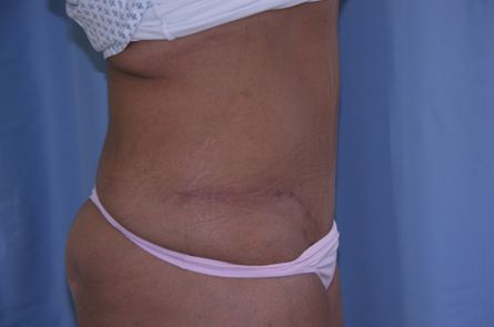 Tummy Tuck Before and After 26