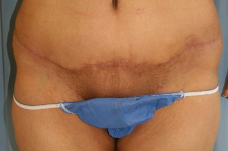 Tummy Tuck Before and After 28