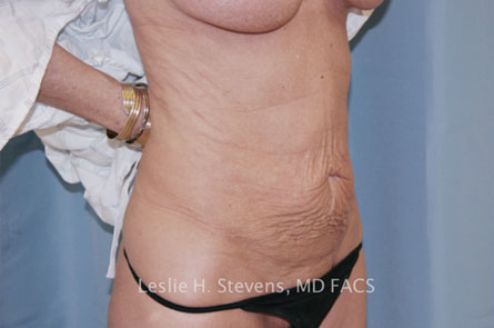 Tummy Tuck Before and After | Dr. Leslie Stevens