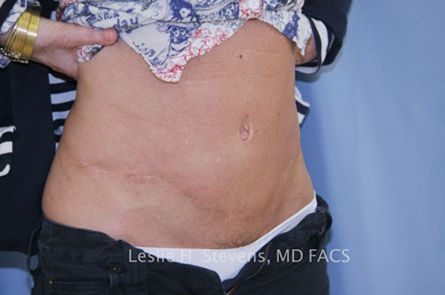 Tummy Tuck Before and After | Dr. Leslie Stevens