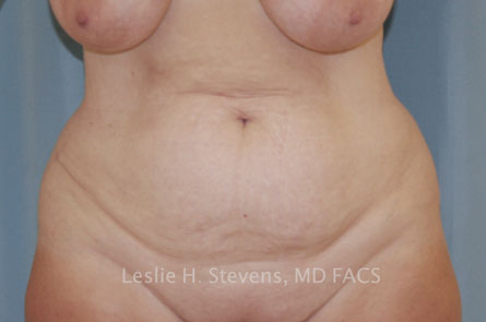 Tummy Tuck Before and After | Dr. Leslie Stevens