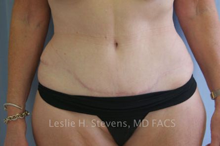 Tummy Tuck Before and After | Dr. Leslie Stevens