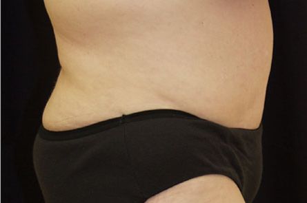 Tummy Tuck Before and After 06