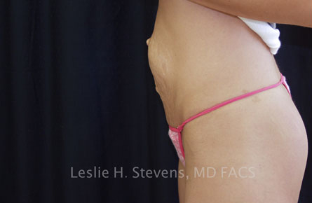 Tummy Tuck Before and After | Dr. Leslie Stevens