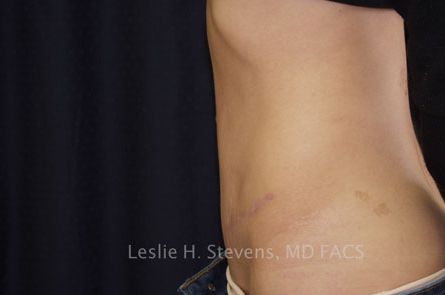 Tummy Tuck Before and After | Dr. Leslie Stevens