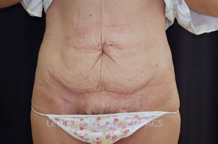 Tummy Tuck Before and After | Dr. Leslie Stevens