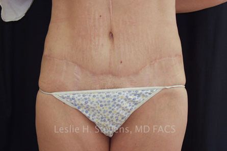 Tummy Tuck Before and After 05