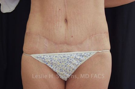 Tummy Tuck Before and After 06