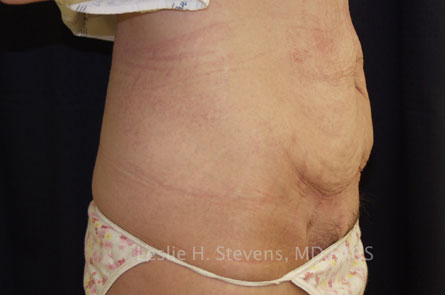 Tummy Tuck Before and After 33