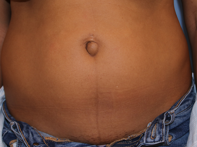 Tummy Tuck Before and After 34