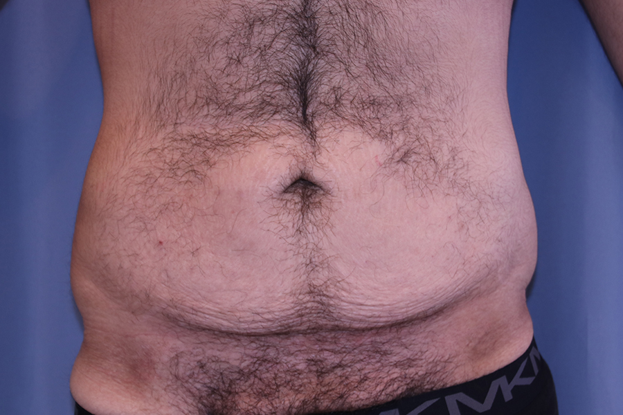 Tummy Tuck Before and After | Dr. Leslie Stevens