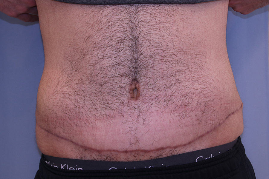 Tummy Tuck Before and After | Dr. Leslie Stevens