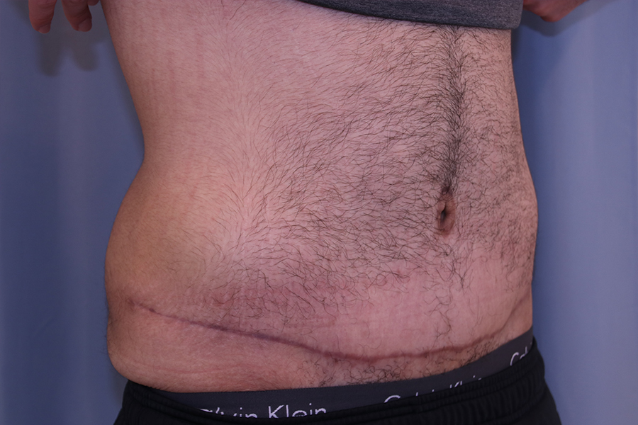 Tummy Tuck Before and After 35