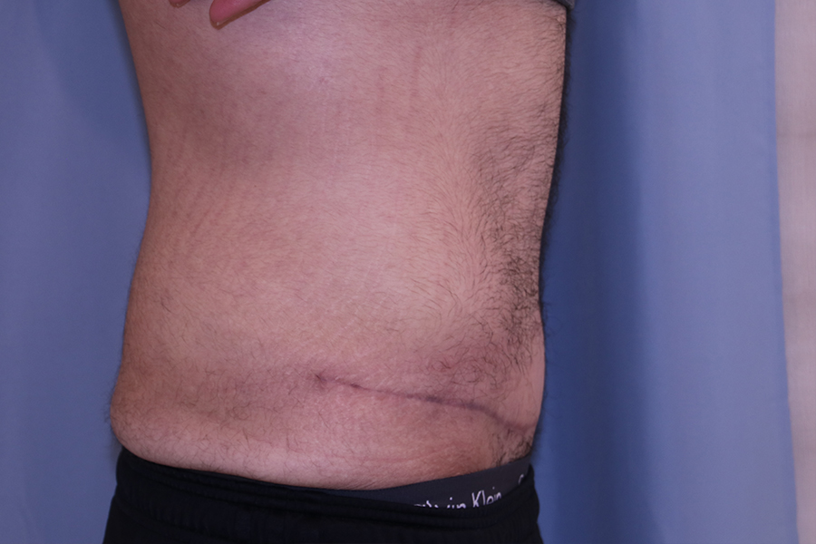 Tummy Tuck Before and After 35