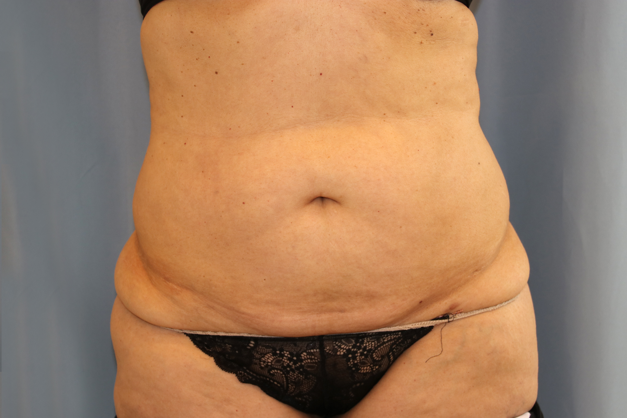 Tummy Tuck Before and After | Dr. Leslie Stevens