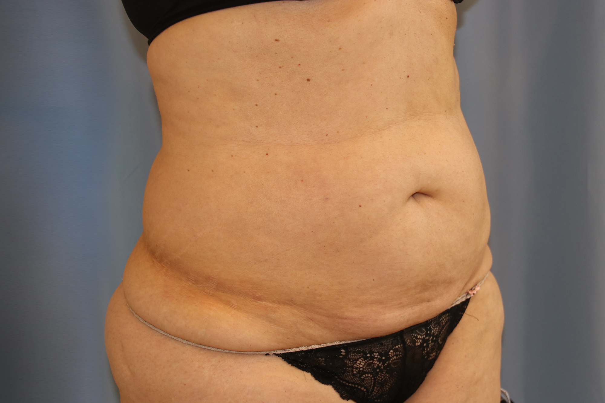 Tummy Tuck Before and After 36