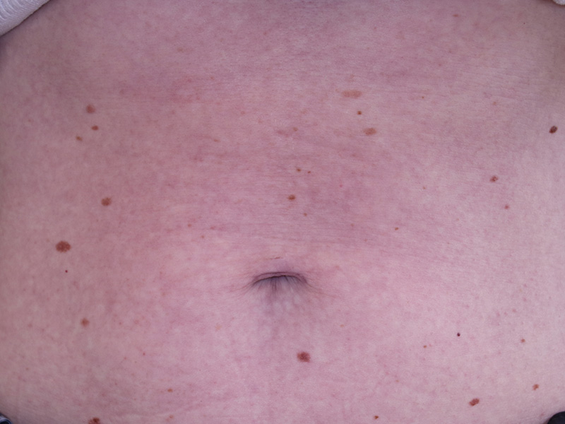 Umbilicoplasty Before and After | Dr. Leslie Stevens