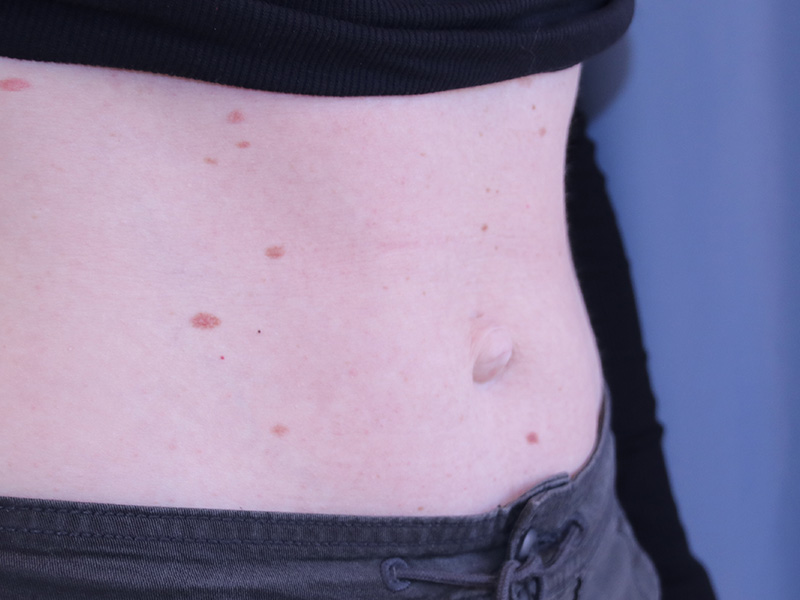Umbilicoplasty Before and After 02