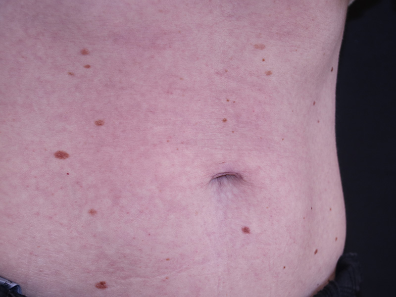Umbilicoplasty Before and After 02