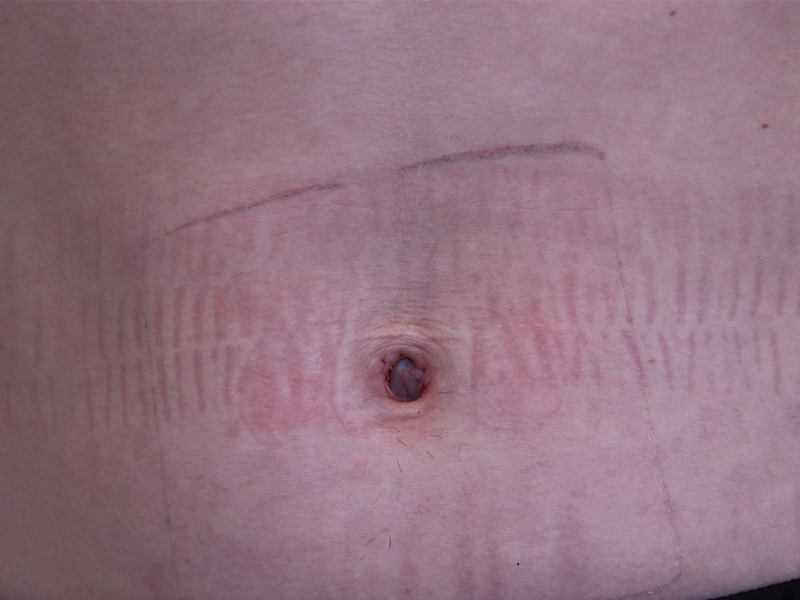 Umbilicoplasty Before and After | Dr. Leslie Stevens