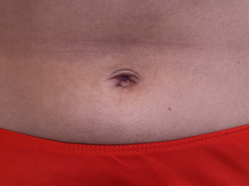 Umbilicoplasty Before and After | Dr. Leslie Stevens