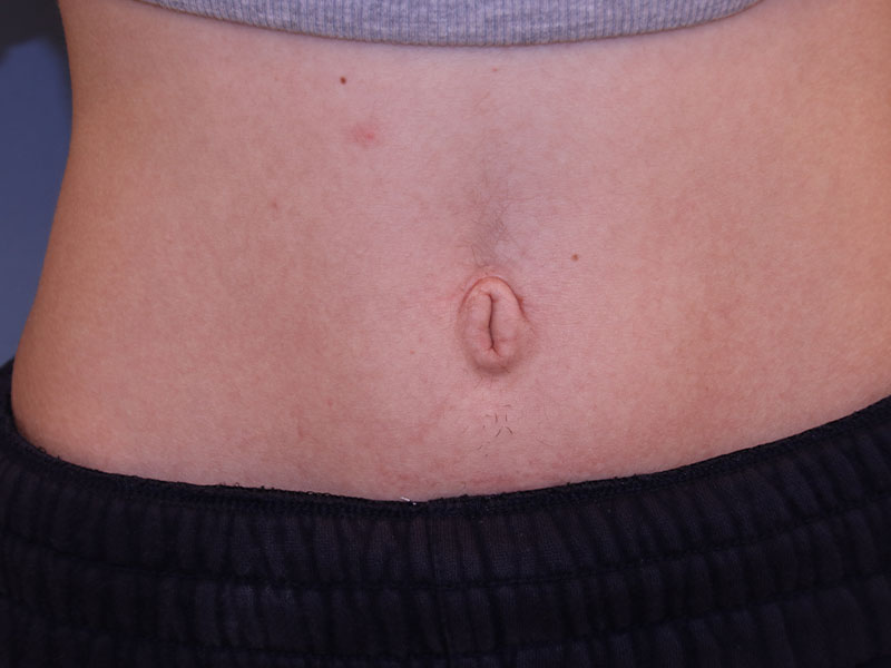 Umbilicoplasty Before and After | Dr. Leslie Stevens