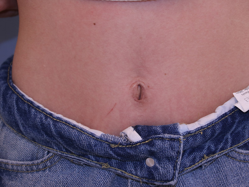 Umbilicoplasty Before and After | Dr. Leslie Stevens